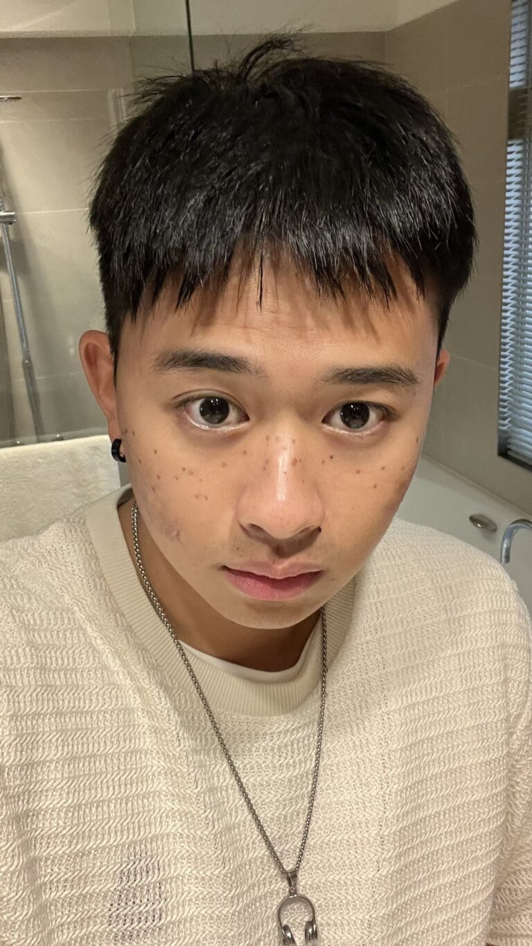 皮秒蜂巢修復期