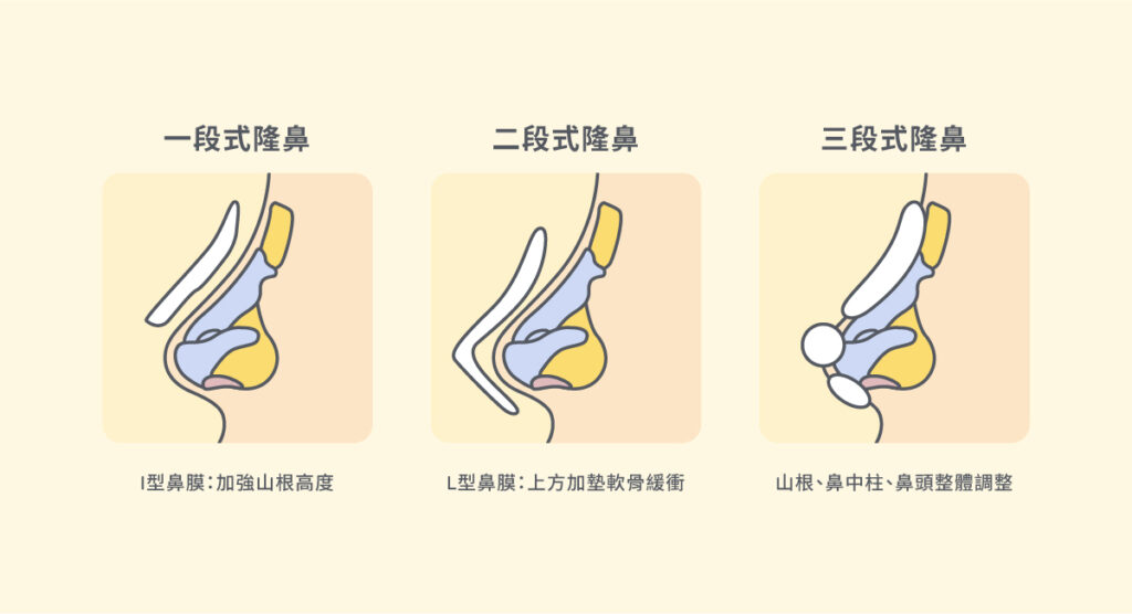 隆鼻手術（結構式隆鼻）原理