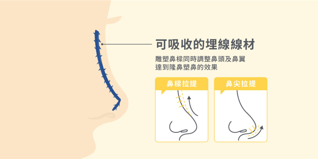 隆鼻費用多少？