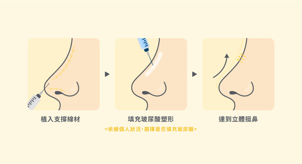 隆鼻方式有哪些