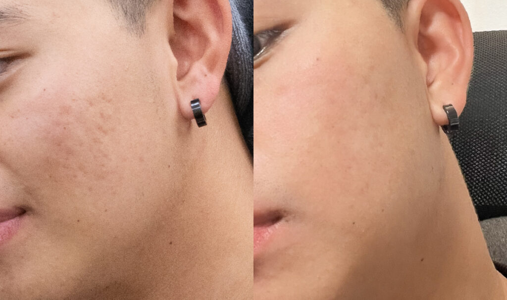 皮秒蜂巢效果對比