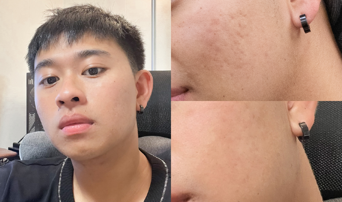 皮秒蜂巢效果對比