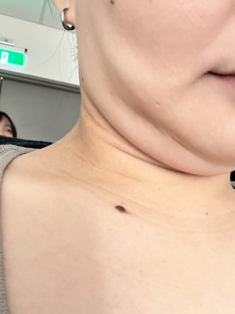 術前雙下巴