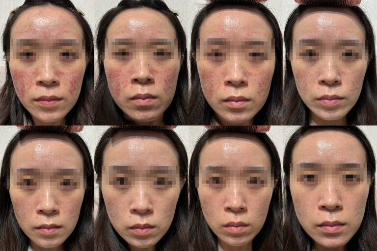 皮秒蜂巢術後恢復紀錄