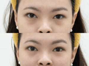 玻尿酸淚溝高雄如意