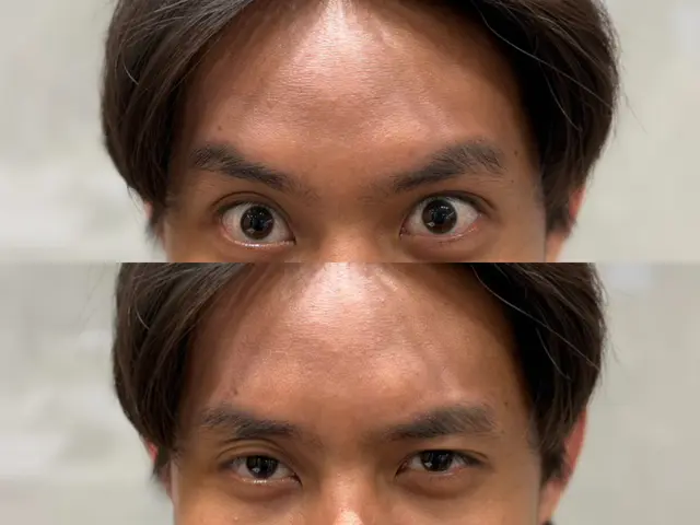 肉毒皺眉術後