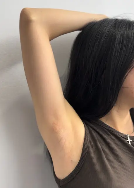 肉毒止汗術後