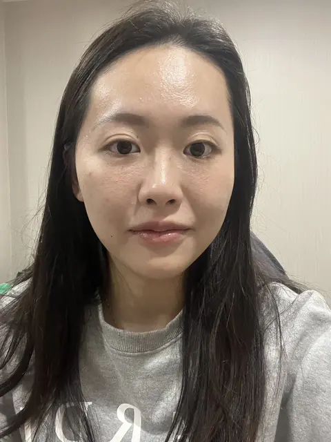 鼻雕術前正面_蔡欣容