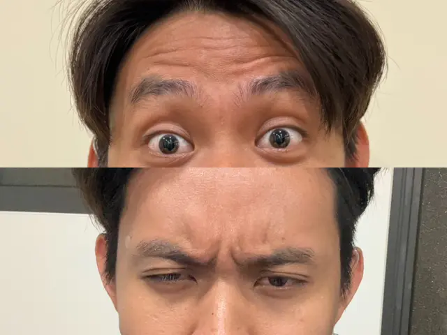 肉毒皺眉前