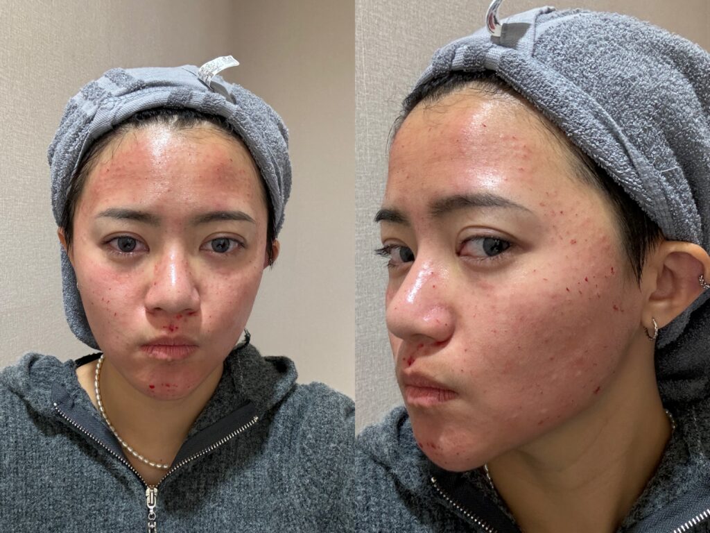 美白水光術後