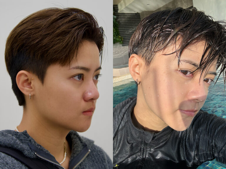 美白水光術後對比