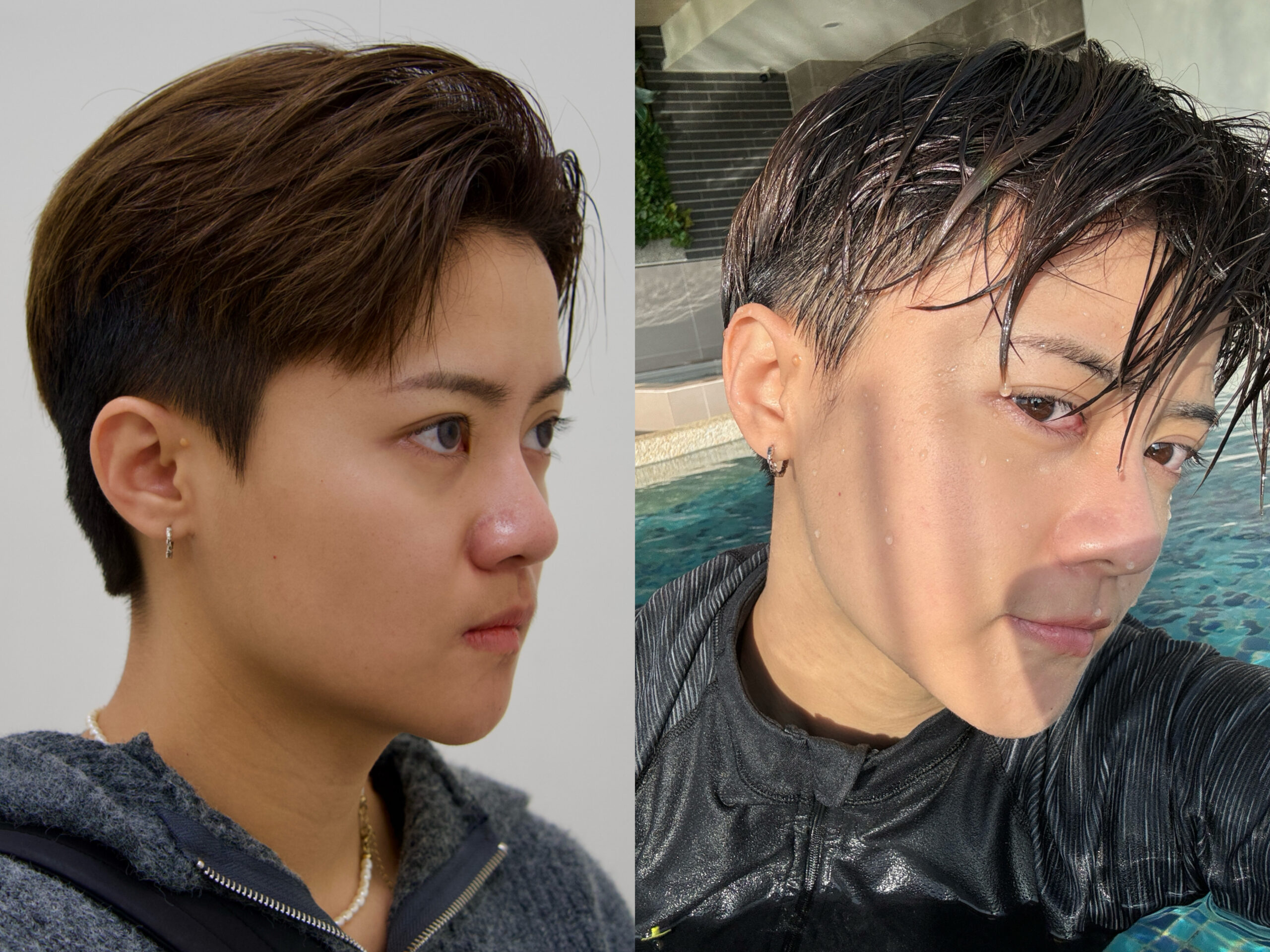 美白水光術後對比