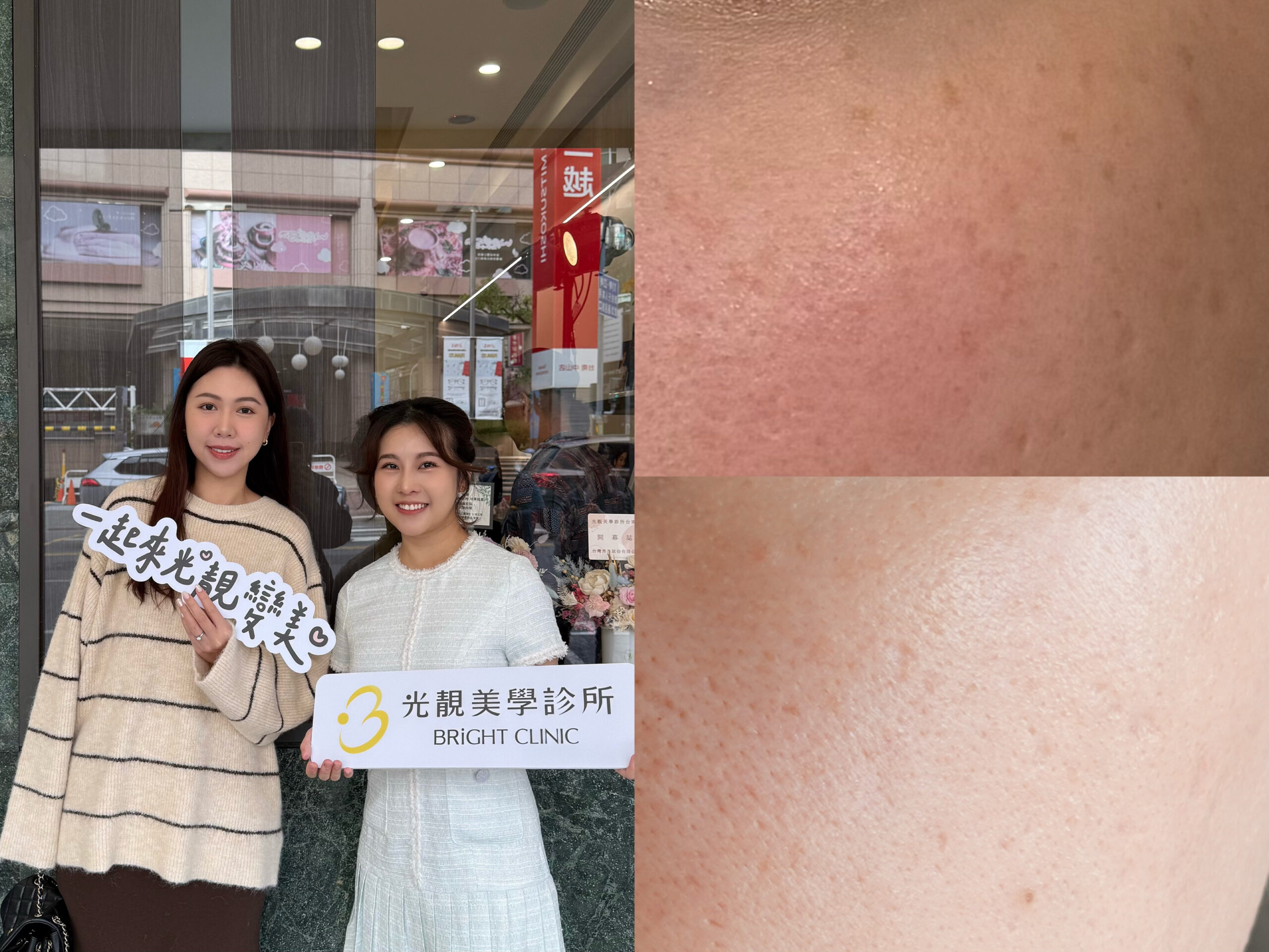 皮秒蜂巢術後對比