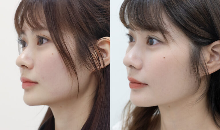 海芙音波術後效果左臉