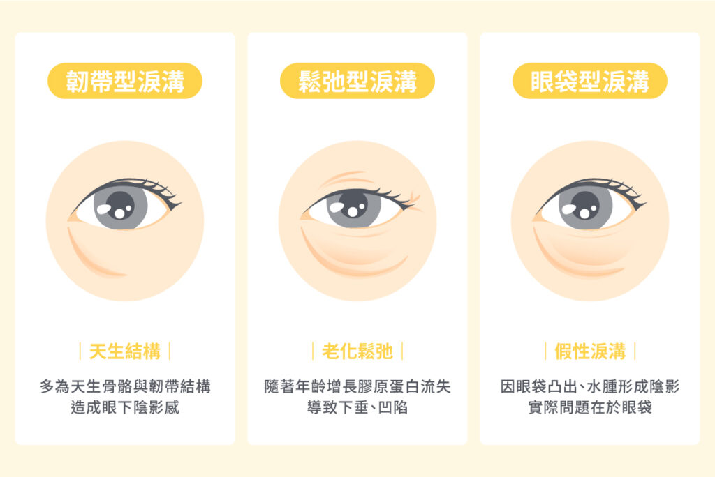 淚溝是什麼-2
