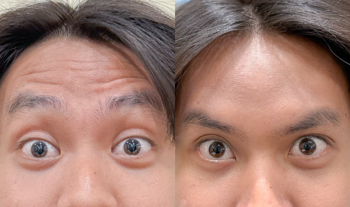 肉毒抬頭皺眉紋效果對比