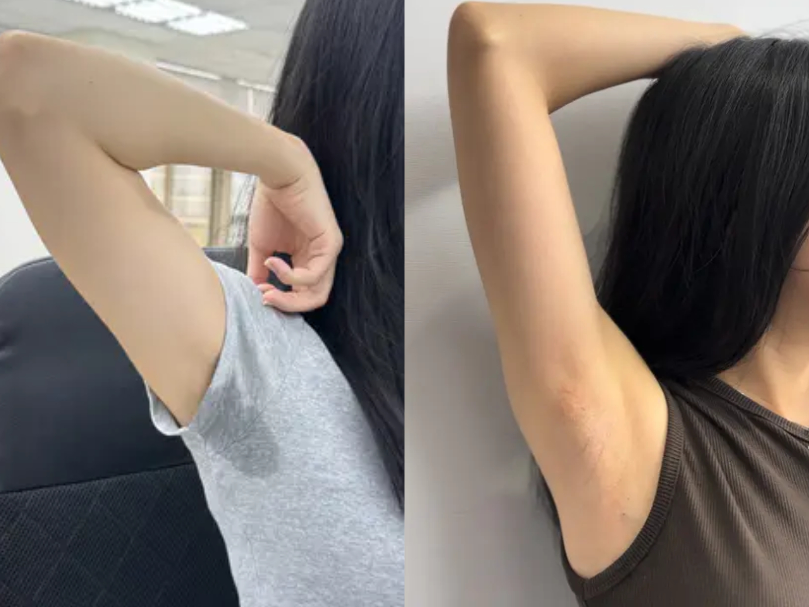 腋下止汗BA