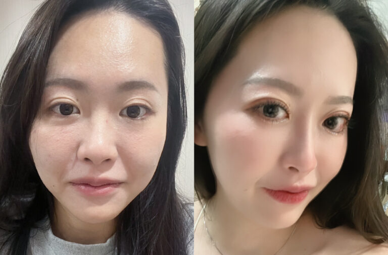 鼻雕埋線術後效果