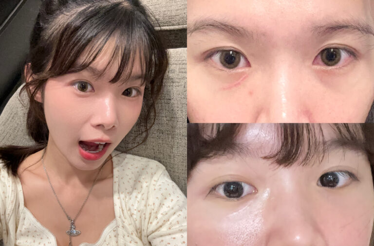 25-0624 網紅依依-消疤針+水光