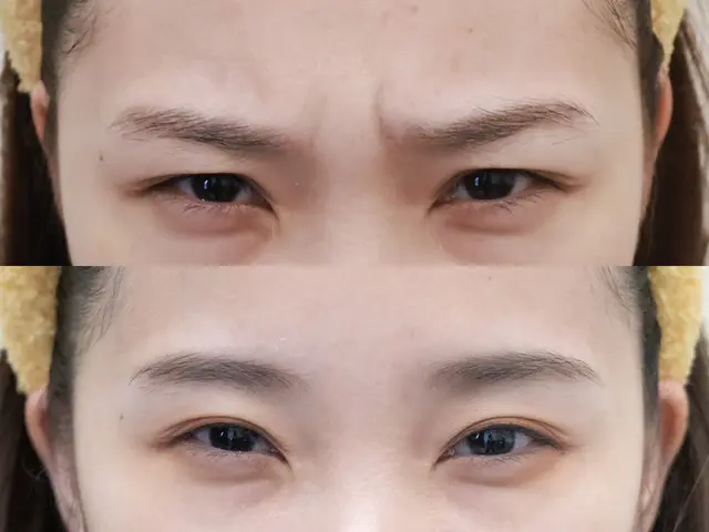 柔柔肉毒皺眉