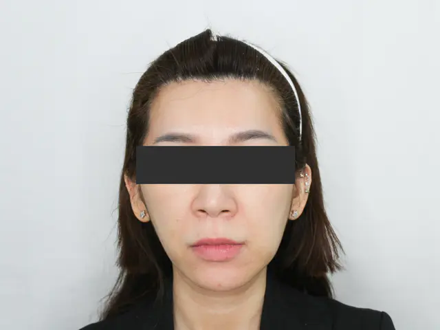 玩美電波術後照
