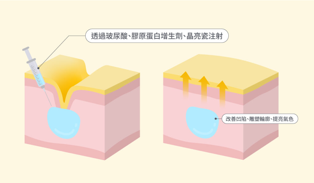 微整醫美填充-2