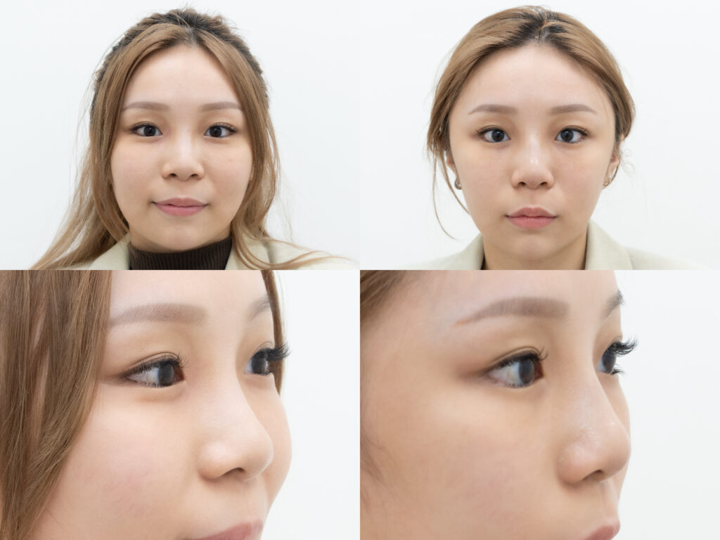 埋線鼻雕BA四宮格