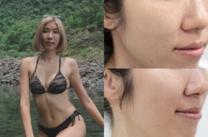 皮秒蜂巢術後效果