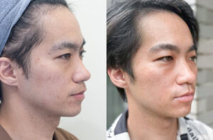 水光針術後效果