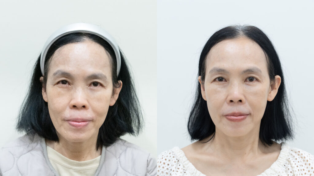 劉媽音波術前術後比較