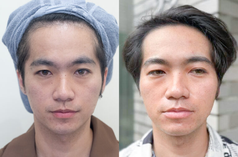 水光針術後效果