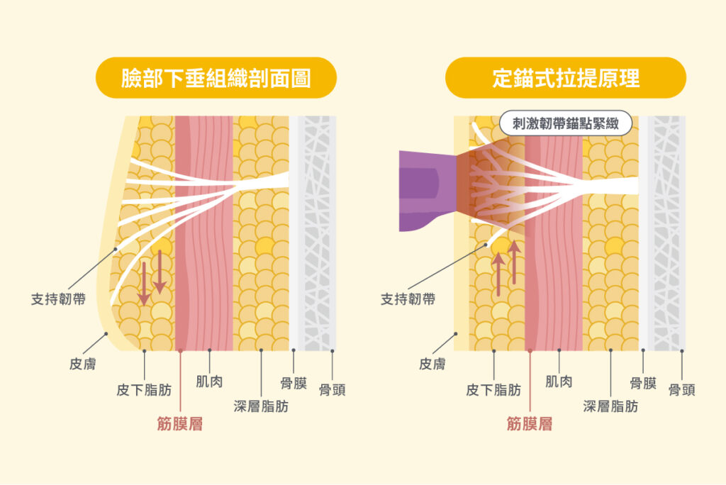 醫美電波拉提-3